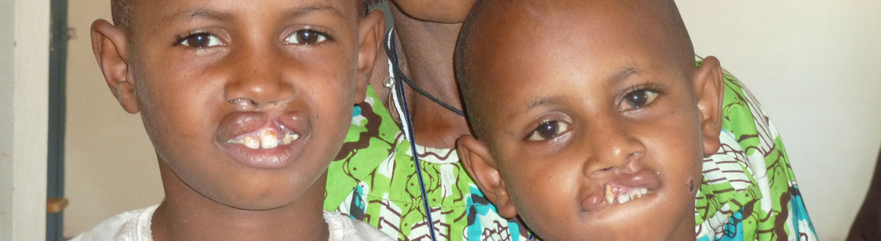 Cleft children in developing countries